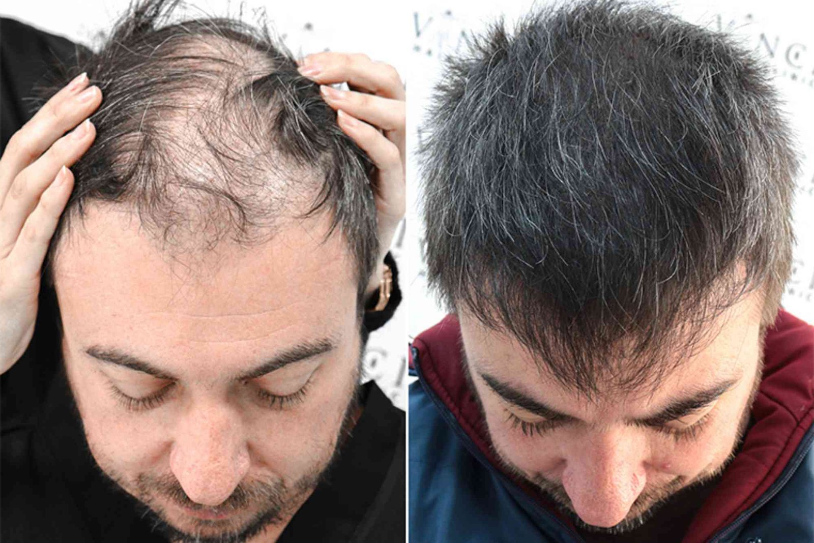 Best Hair Transplat Turkey